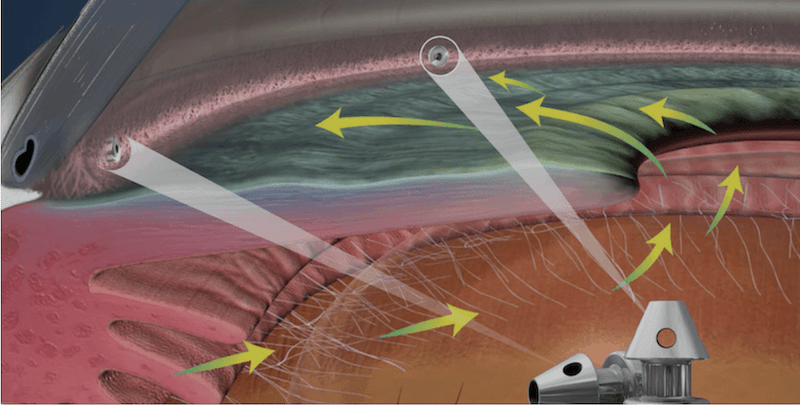 iStent Tratando o Glaucoma