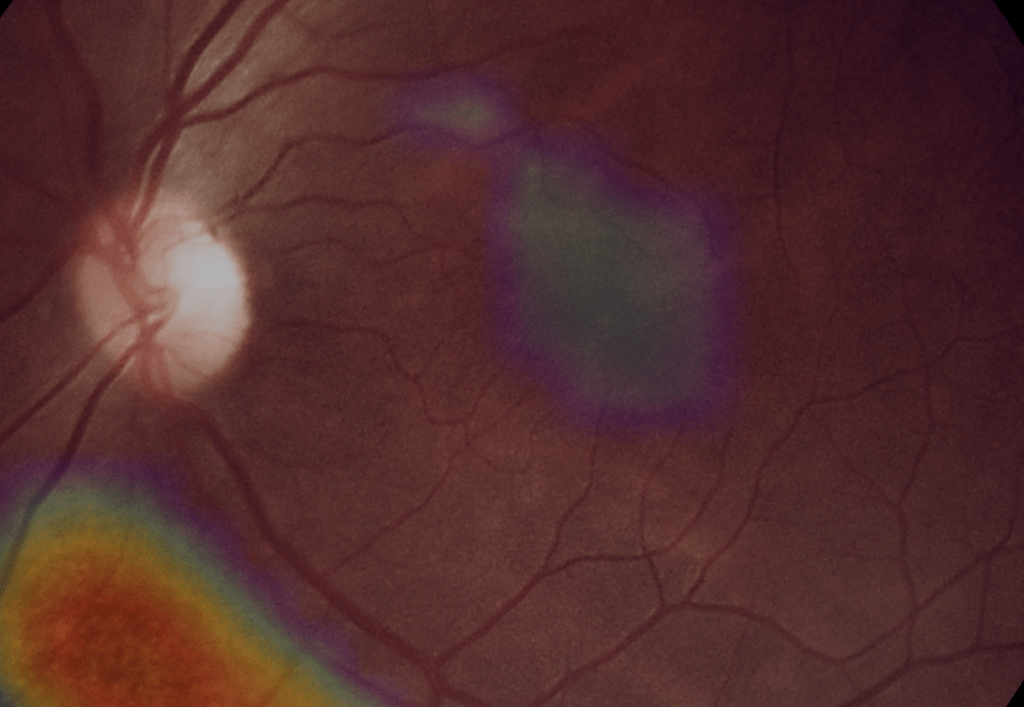 Retinografia Feita com o Eyer2, mostrando uma membrana epirretiniana