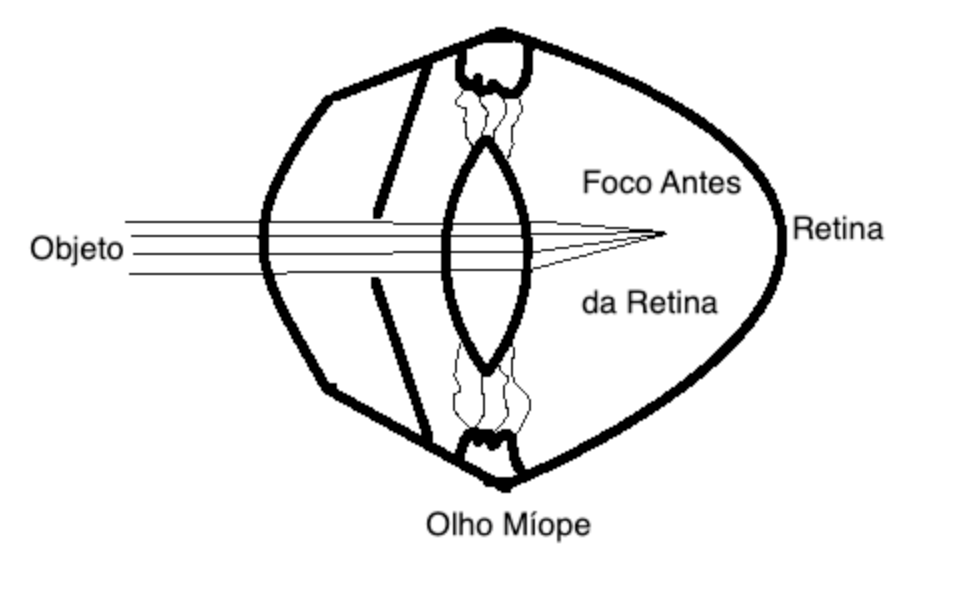 OLHO MÍOPE: REPRESENTAÇÃO ESQUEMÁTICA