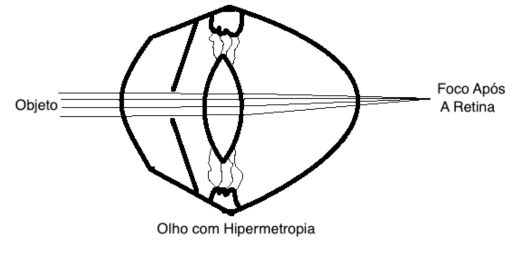 OLHO HIPERMÉTROPE, REPRESENTAÇÃO ESQUEMÁTICA